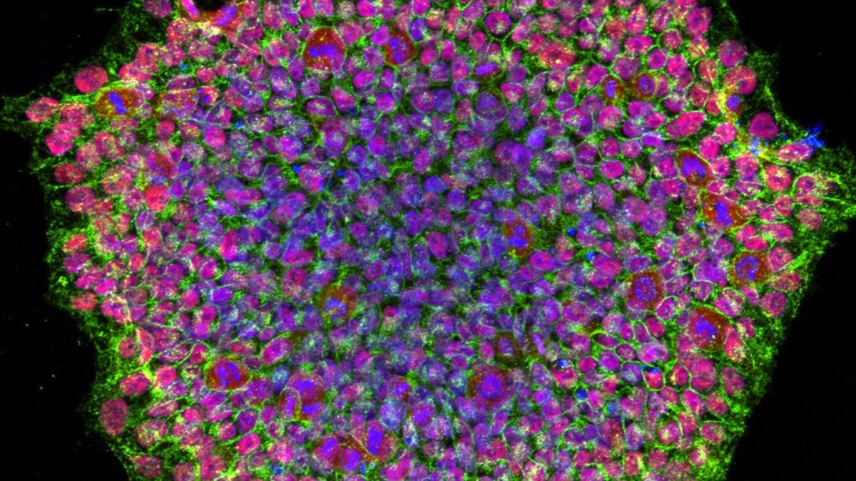 Human induced-pluripotent stem-cell colony under immunofluorescence showing surface-marker staining — stem-cell purity and characterisation, Panacea Bio Chem, Bogdan Dicoias